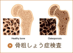 骨粗しょう症外来
